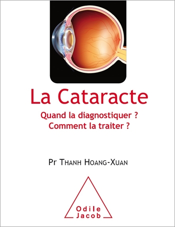 Cataracte (La) - Quand la diagnostiquer ? Comment la traiter ?